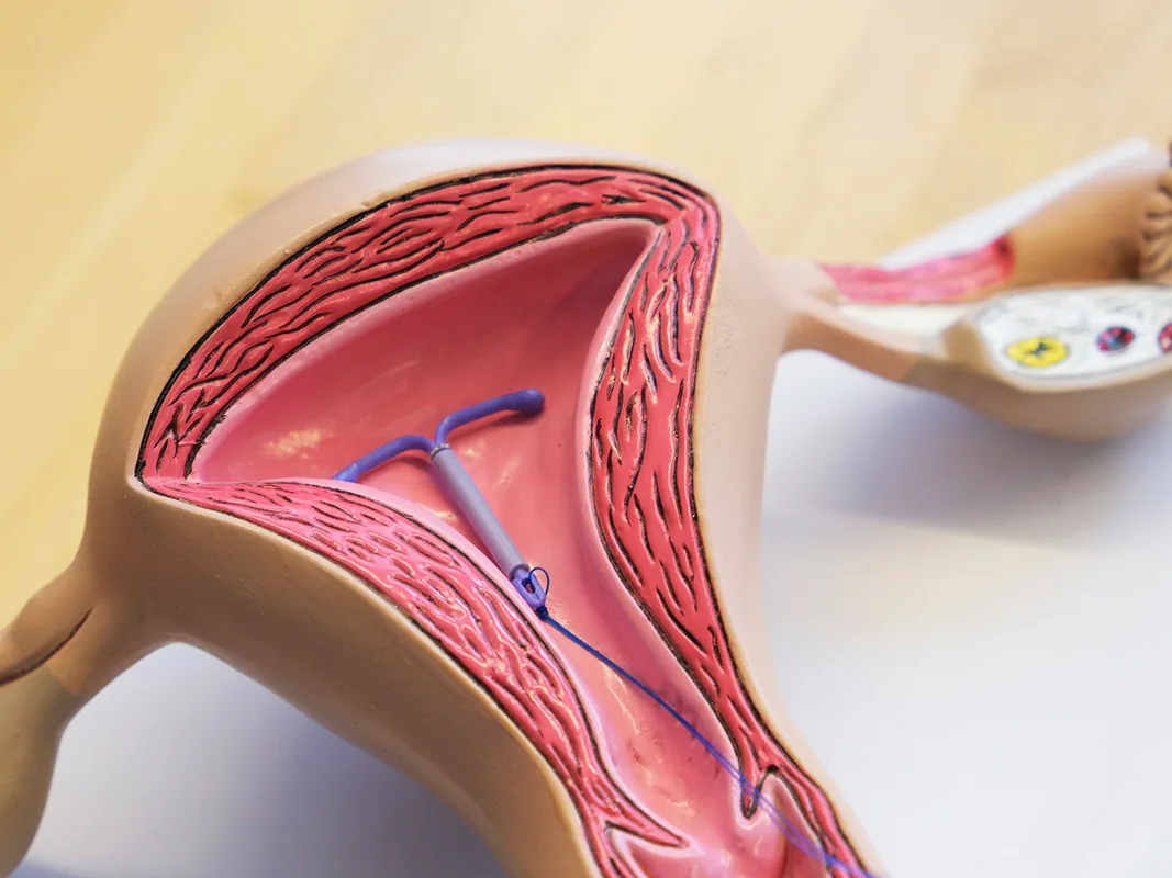 Anatomisches Modell der weiblichen Geschlechtsorgane mit Spirale zur Verhütungsberatung