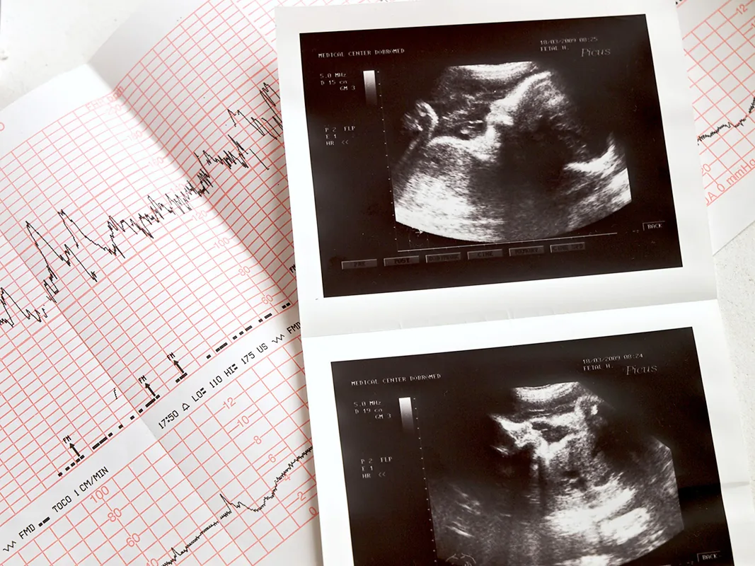 Vorgeburtliche Diagnostik und Ultraschall Ultraschallbilder und CTG-Streifen der vorgeburtlichen Diagnostik